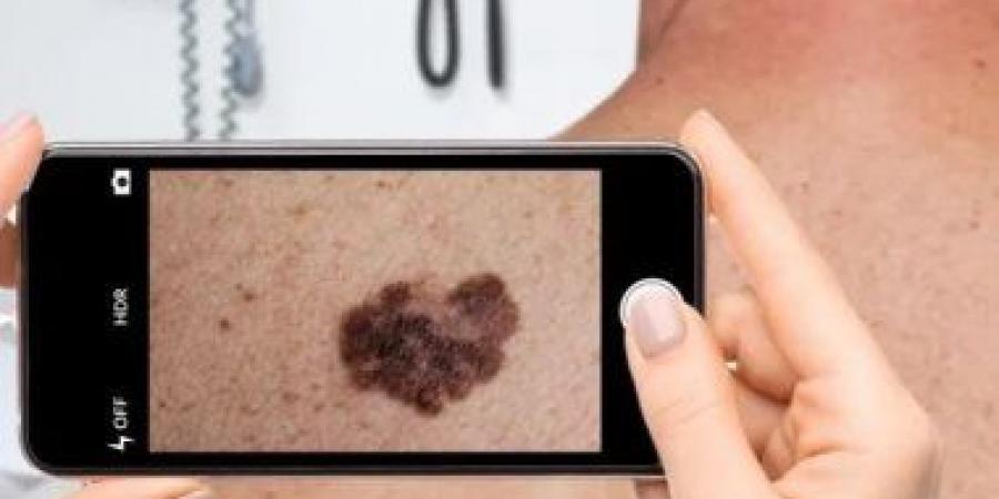 بالبلدي: تطبيق جديد يستخدم الذكاء الاصطناعى لتصنيف حالات سرطان الجلد بالتقاط صورة
