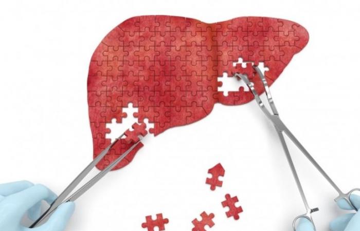 بالبلدي : درجات تليف الكبد وأسبابه وأعراضه