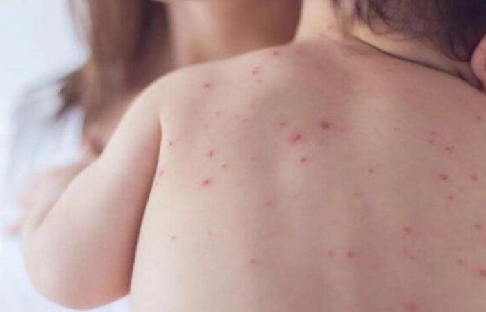 بالبلدي: الحملة
      القومية
      للتطعيم
      ضد
      الحصبة
      تنطلق
      رسميًا..
      الأماكن
      والمواعيد
      بالتفصيل