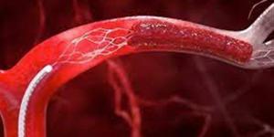 بالبلدي : ما هي حالات تمدد الأوعية الدموية؟.. تعرف على تفاصيل أنواعها