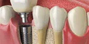 بالبلدي : تطور مجال زراعة الأسنان والفك الكامل.. وطبيب يكشف عدد جلسات الزراعة