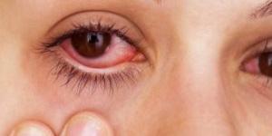 بالبلدي : سرطان العيون.. طبيب يكشف عن أبرز الأعراض