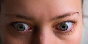 بالبلدي : أعراض مرض جريفز.. جحوظ العينين أبرزها