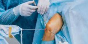 بالبلدي : استشاري يوضح مزايا منظار الركبة في الجراحة العادية