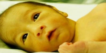 بالبلدي : ما هي أسباب اليرقان عند حديثي الولادة؟.. أخصائي يجيب