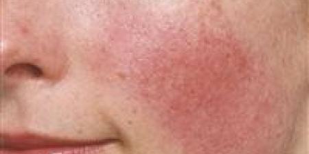بالبلدي : سخونة وبقع الوجه.. علاج حالة الجلد الوردية عن طريق دواء الصداع النصفي | دراسة