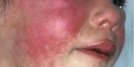 بالبلدي : أخصائية تكشف أعراض الحمى الوردية.. تستمر الحرارة 3 أيام وظهور طفح جلدي