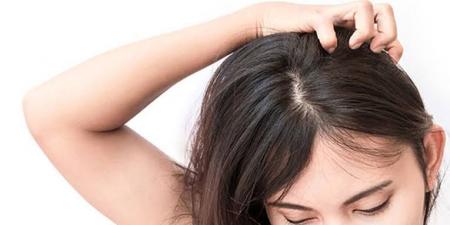 بالبلدي: 5 مكونات طبيعية فعالة للقضاء على قشر الشعر في الصيف