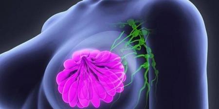 بالبلدي : جراحة السمنة تقلل خطر الإصابة بـ سرطان الثدي| دراسة