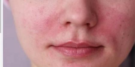 بالبلدي : أبرز أسباب الطفح الجلدي في الوجه.. أخصائية تكشف معلومات مهمة