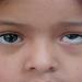بالبلدي : أسباب كسل العين عند الأطفال.. قصر النظر من بينها