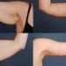 بالبلدي : أجنحة البنغو.. تمرين بسيط للتخلص من ترهل الجلد أسفل الذراعين