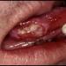بالبلدي: الصحة: أضرار كارثية على الأسنان نتيجة التدخين belbalady.net