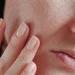 بالبلدي : هل الصحة النفسية تؤثر على الجلد؟
