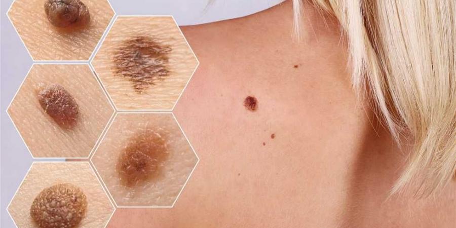 بالبلدي : خبراء يحذرون من 6 علامات لـ سرطان الجلد