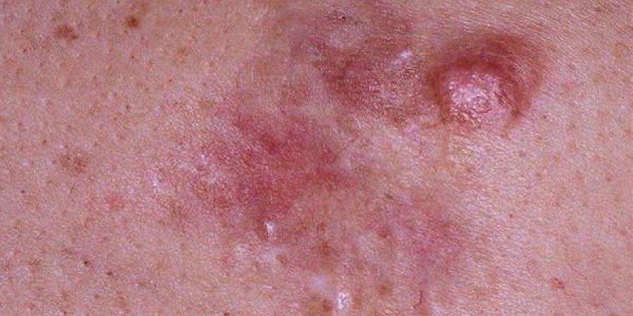 بالبلدي : أعراض الساركوما الليفية الجلدية الحدبية.. احذر ظهور بقعة جلدية خشنة